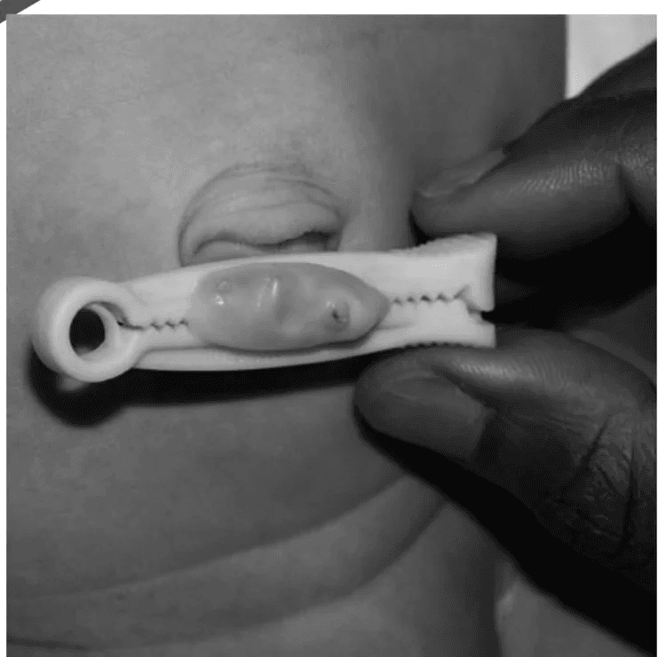 A Quick Guide to Umbilical Cord Care